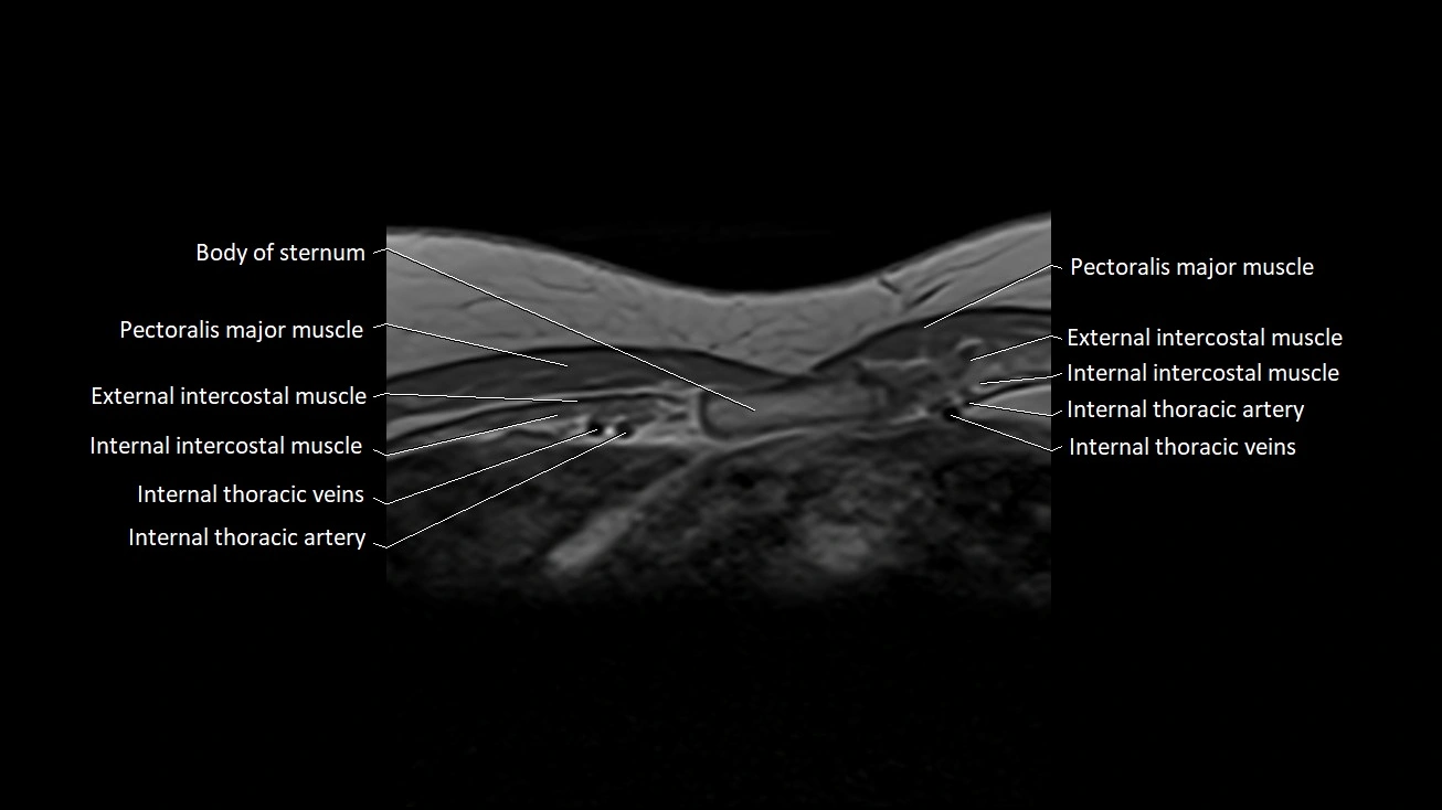 MRI sternum and sternoclavicular joint labeled axial anatomy image 22.webp